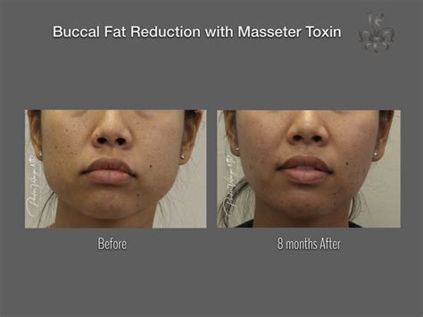 Buccal Fat Removal Case 3641 New Orleans Premier Center For Aesthetics And Plastic Surgery