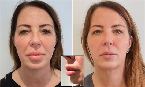 Woman Who Had Lip Fillers Reveals How Treatment Left Her With Nightmare