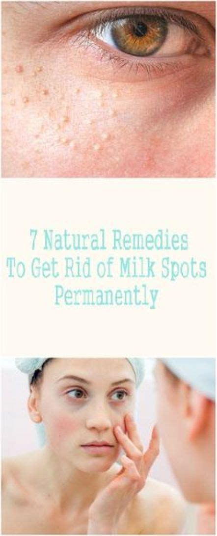 7 Natural Remedies To Get Rid Of Milk Spots Permanently Health And