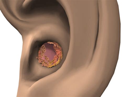 What Earwax Can Tell You About Your Health And How To Get