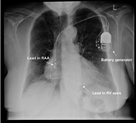 Icd Vs Pacemaker Cxr Chest X Ray Pa Male Patient Vvir Pacemaker On