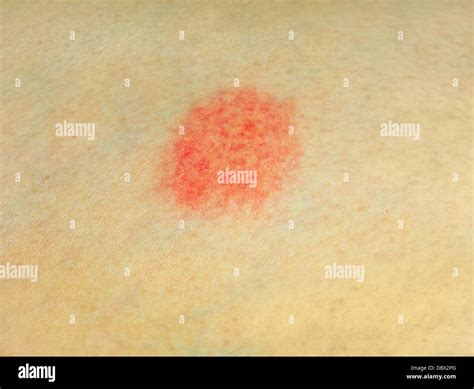 Red Spot On Skin Stock Photo Alamy