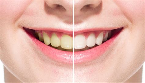 تعرف على علاج تصبغات الأسنان الصفراء وما هي طرق الوقاية منها؟ المركز الطبي لرعاية الأسنان