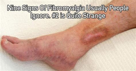 This constriction causes the pain to radiate to other areas. How to Self-Diagnose Fibromyalgia - Fibromyalgia Community
