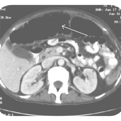 A B And C Abdominal Ct Showing Air Fluid Level With A Dilated