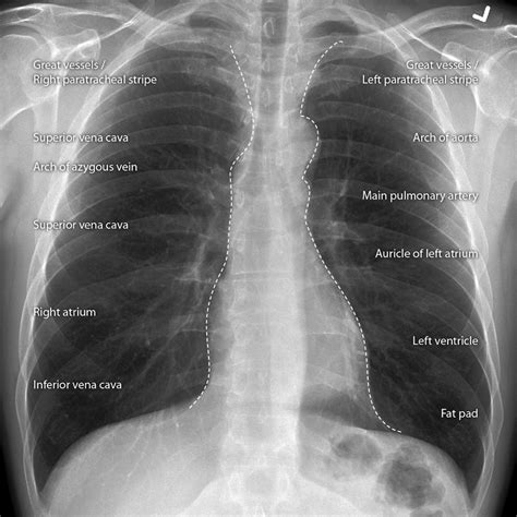Anatomy Of Chest X Ray 5 2 Approach To The Chest X Ray Cxr Medicine