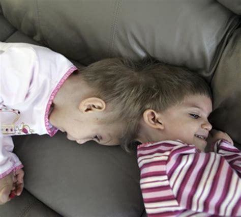 Surgeons Begin First Major Operation On Conjoined Twins The Daily Illini