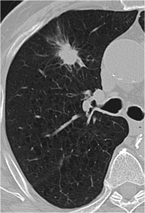 Malignant Pulmonary Solitary Nodules High Resolution Computed Tomography Morphologic And