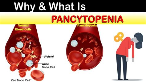 Why What Is Pancytopenia Youtube