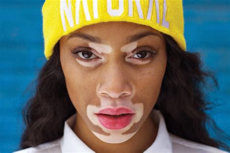 Winnie Harlow Om Sin Vitiligo Jag Har Lärt Mig Att älska Mig Själv