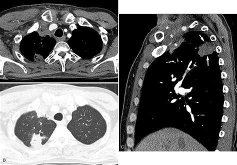 A Follow Up Chest Ct Scan At 3 Months After Radiation Therapy Showing