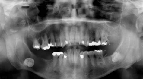 Dentigerous Cyst Pictures Symptoms Causes Treatment