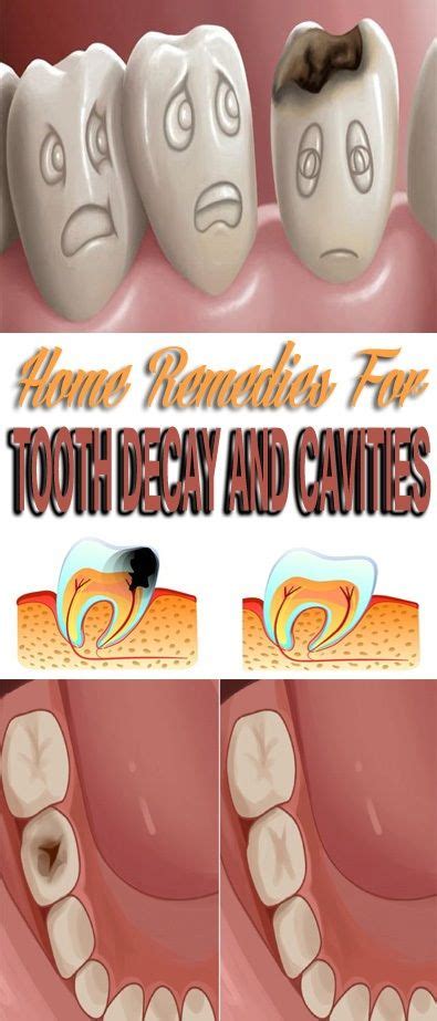Home Remedies For Tooth Decay And Cavities Tooth Decay Oral Care