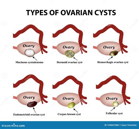 Types De Kystes Ovariens Positionnement Infographie Illustration De