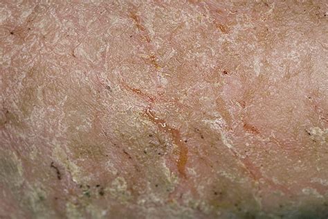 Venous Eczema Pictures 174 Photos And Images