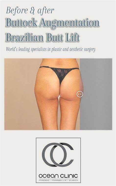 Pin On Buttock Augmentation Before After Brazilian Butt