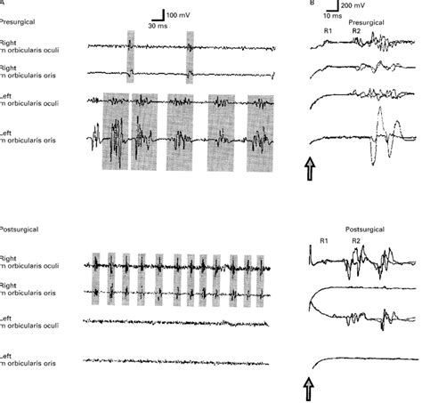 Four Channel Surface Emg Recording From Orbicularis Oculi And Oris