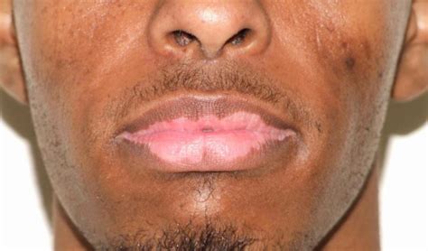 Cause And How To Get Rid Of Vitiligo On Lips Or Face Skincarederm