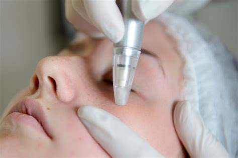 8 Key Things You Need To Know About Microdermabrasion