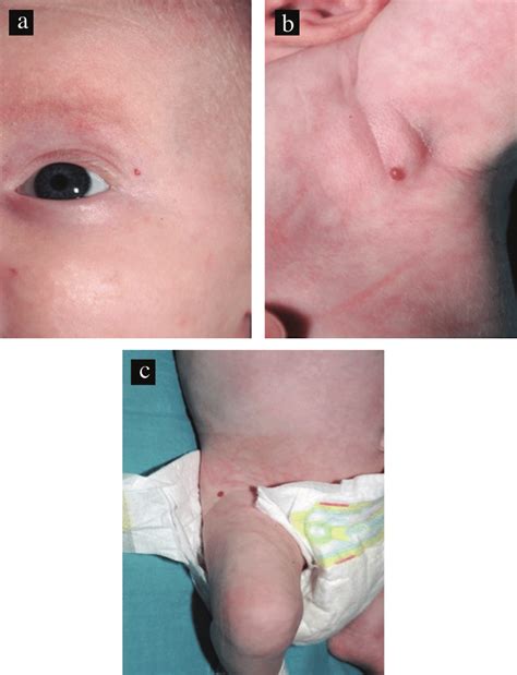Cutaneous Infantile Hemangiomas A At The Left Lateral Canthus B Left