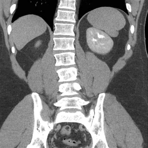 Normal Spleen Coronal View CT Of