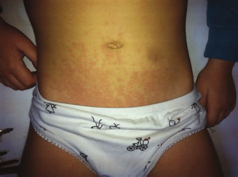 Typical Rash In Systemic Juvenile Idiopathic Arthritis Download