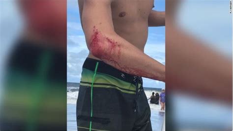 There Were Two Shark Attacks Off The Coast Of Florida This Weekend Wpec