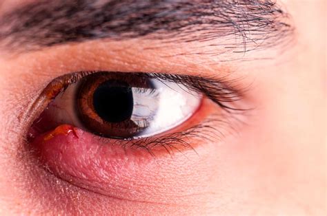 Sore Eyelids Eye Health Library Bc Doctors Of Optometry
