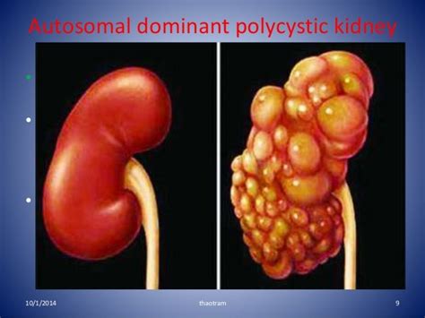 Adult Polycystic Kidney Disease