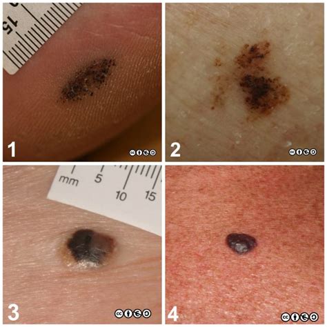 Skin Surgery And Therapy 2 Skin Cancer 909
