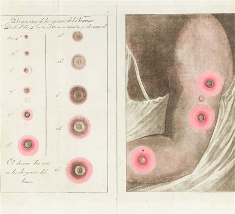 Illustration Of Smallpox Vaccination Scars