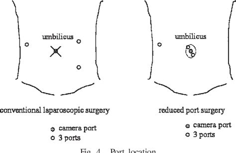 figure 4 from a case of laparoscopic ileocecal resection for intussusception secondary to cecal