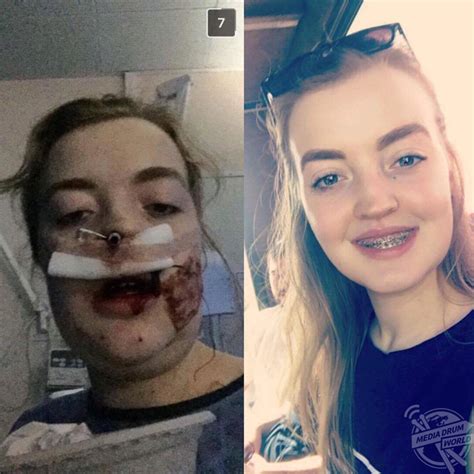This Woman Was Bullied For Her Unusually Large Under Bite But Is Almost