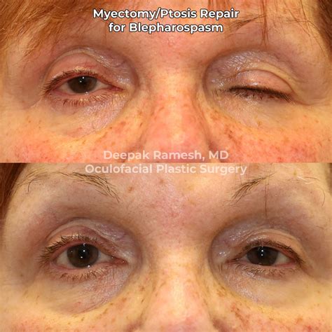 Blepharospasm And Facial Spasm In Nj Center For Eye And Facial