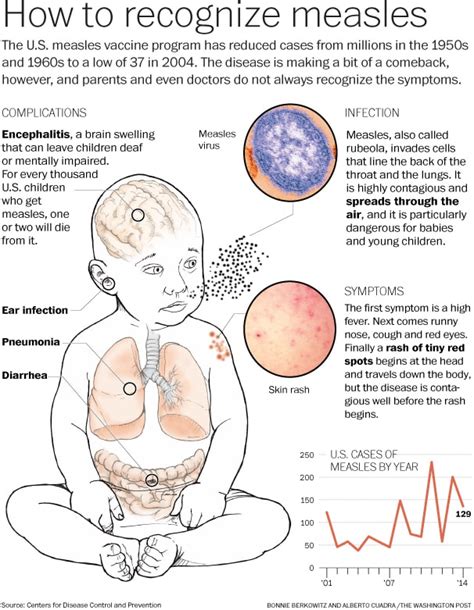 Us Measles Outbreak Sets Record For Post Elimination Era The