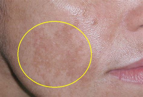 Dark Spots Will Immediately Be Gone Using These Effective Remedies