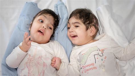 3d Printing Helps To Separate Conjoined Twin Girls During An Operation