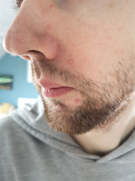 Tips For These Irritating Cluster Acne