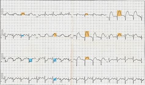 File12 Lead Ekg St Elevation Tracing Color Coded Wikipedia The