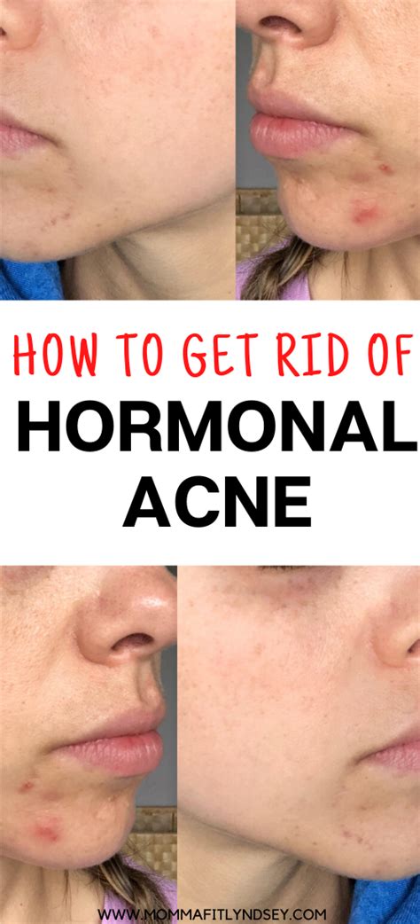 Treat Hormonal Acne With Gut Healing Foods Chin Acne Cystic Acne