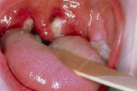Infected Tonsils In Glandular Fever Stock Image M1650061 Science