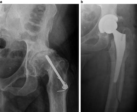 Periprosthetic Fracture Of The Femur After Total Hip Arthroplasty
