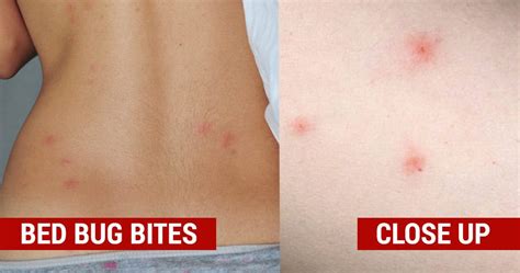 Types Of Bug Bites In Bed Aslofone