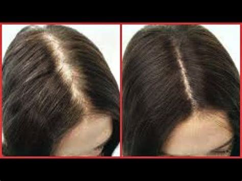 Vitamin c may also help to promote faster hair regrowth when taken as a supplement. HOW TO REGROW HAIR ON BALD SPOT, EDGES, THINNING HAIR ...