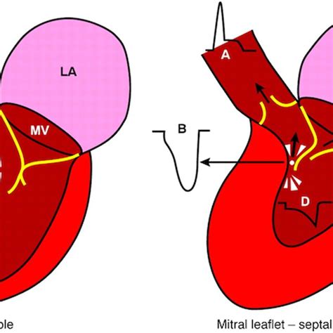 Left Ventricular Lv Outflow Tract Obstruction Due To Narrowing Of The