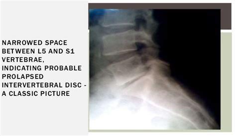Prolapsed Intervertebral Disc X Ray Click To Enlarge Image Side