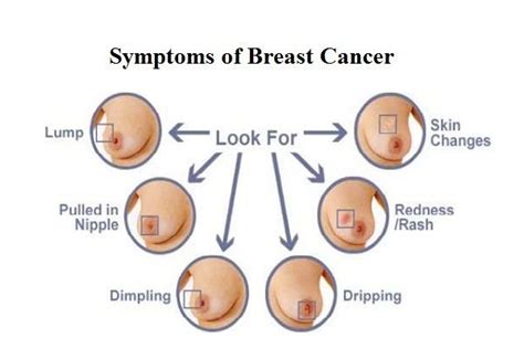 If dimpling affects both breasts, the person probably does not have breast cancer. Symptoms and Causes of Breast Cancer | Health and Fitness