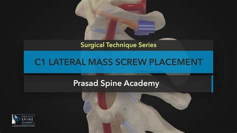 Surgical Techniques C1 Lateral Mass Screws Youtube