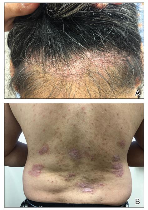 Psoriasis In Patients Of Color Differences In Morphology Clinical