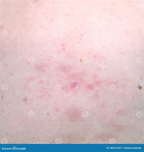 Woman With Shingles Or Herpes Zoster On Skin It Is Raised Red Bumps